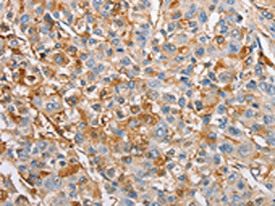 The image on the left is immunohistochemistry of paraffin-embedded Human liver cancer tissue using CSB-PA546577(IKBKG Antibody) at dilution 1/60, on the right is treated with fusion protein. (Original magnification: ×200)