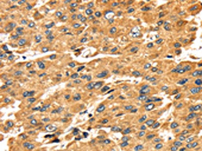 The image on the left is immunohistochemistry of paraffin-embedded Human liver cancer tissue using CSB-PA546597(SH3KBP1 Antibody) at dilution 1/45, on the right is treated with fusion protein. (Original magnification: ×200)