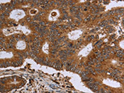 The image on the left is immunohistochemistry of paraffin-embedded Human colon cancer tissue using CSB-PA546696(HSD17B4 Antibody) at dilution 1/30, on the right is treated with fusion protein. (Original magnification: ×200)