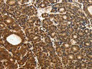 The image on the left is immunohistochemistry of paraffin-embedded Human thyroid cancer tissue using CSB-PA546739(ODC1 Antibody) at dilution 1/30, on the right is treated with fusion protein. (Original magnification: ×200)