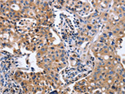 The image on the left is immunohistochemistry of paraffin-embedded Human lung cancer tissue using CSB-PA546880(ITGB5 Antibody) at dilution 1/40, on the right is treated with fusion protein. (Original magnification: ×200)