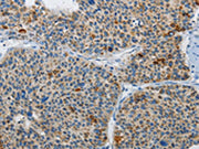 The image on the left is immunohistochemistry of paraffin-embedded Human liver cancer tissue using CSB-PA547032(ATG4A Antibody) at dilution 1/30, on the right is treated with synthetic peptide. (Original magnification: ×200)