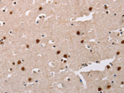 The image on the left is immunohistochemistry of paraffin-embedded Human brain tissue using CSB-PA547116(AKAP8L Antibody) at dilution 1/20, on the right is treated with fusion protein. (Original magnification: ×200)