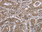 The image on the left is immunohistochemistry of paraffin-embedded Human gastic cancer tissue using CSB-PA547383(IPO8 Antibody) at dilution 1/50, on the right is treated with synthetic peptide. (Original magnification: ×200)