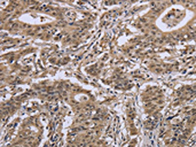 The image on the left is immunohistochemistry of paraffin-embedded Human gastic cancer tissue using CSB-PA547383(IPO8 Antibody) at dilution 1/50, on the right is treated with synthetic peptide. (Original magnification: ×200)