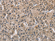 The image on the left is immunohistochemistry of paraffin-embedded Human liver cancer tissue using CSB-PA547426(PGK1 Antibody) at dilution 1/40, on the right is treated with fusion protein. (Original magnification: X200)