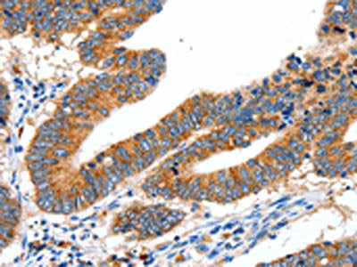 The image on the left is immunohistochemistry of paraffin-embedded Human colon cancer tissue using CSB-PA547464(SLC2A1 Antibody) at dilution 1/40, on the right is treated with synthetic peptide. (Original magnification: ×200)