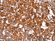 The image on the left is immunohistochemistry of paraffin-embedded Human thyroid cancer tissue using CSB-PA547529(HAS1 Antibody) at dilution 1/30, on the right is treated with synthetic peptide. (Original magnification: ×200)
