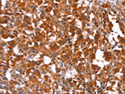 The image on the left is immunohistochemistry of paraffin-embedded Human thyroid cancer tissue using CSB-PA547529(HAS1 Antibody) at dilution 1/30, on the right is treated with synthetic peptide. (Original magnification: ×200)