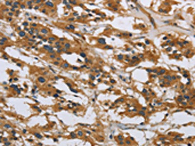 The image on the left is immunohistochemistry of paraffin-embedded Human thyroid cancer tissue using CSB-PA547751(IL5RA Antibody) at dilution 1/40, on the right is treated with synthetic peptide. (Original magnification: ×200)
