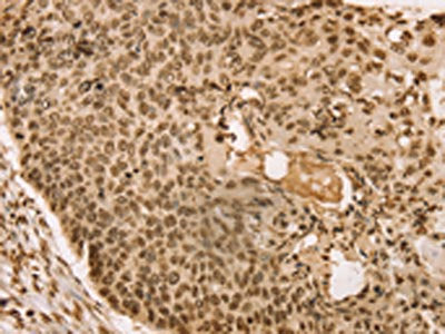 The image on the left is immunohistochemistry of paraffin-embedded Human esophagus cancer tissue using CSB-PA547919(SNX8 Antibody) at dilution 1/30, on the right is treated with fusion protein. (Original magnification: ×200)