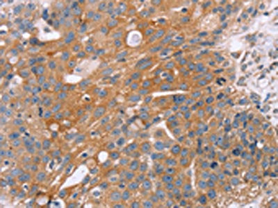 The image on the left is immunohistochemistry of paraffin-embedded Human breast cancer tissue using CSB-PA548038(OPTN Antibody) at dilution 1/25, on the right is treated with fusion protein. (Original magnification: ×200)