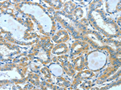 The image on the left is immunohistochemistry of paraffin-embedded Human thyroid cancer tissue using CSB-PA548094(SPHK2 Antibody) at dilution 1/60, on the right is treated with fusion protein. (Original magnification: ×200)