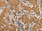 The image on the left is immunohistochemistry of paraffin-embedded Human gastic cancer tissue using CSB-PA548176(EPPIN Antibody) at dilution 1/25, on the right is treated with synthetic peptide. (Original magnification: ×200)