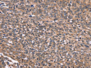 The image on the left is immunohistochemistry of paraffin-embedded Human ovarian cancer tissue using CSB-PA548371(GPR65 Antibody) at dilution 1/20, on the right is treated with synthetic peptide. (Original magnification: ×200)