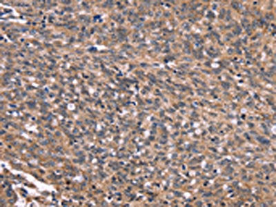 The image on the left is immunohistochemistry of paraffin-embedded Human ovarian cancer tissue using CSB-PA548371(GPR65 Antibody) at dilution 1/20, on the right is treated with synthetic peptide. (Original magnification: ×200)