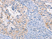 The image on the left is immunohistochemistry of paraffin-embedded Human cervical cancer tissue using CSB-PA548882(CCR5 Antibody) at dilution 1/15, on the right is treated with synthetic peptide. (Original magnification: ×200)