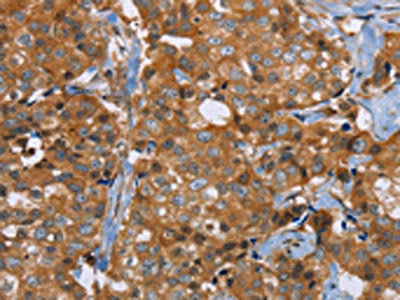 The image on the left is immunohistochemistry of paraffin-embedded Human breast cancer tissue using CSB-PA548912(P2RY1 Antibody) at dilution 1/40, on the right is treated with synthetic peptide. (Original magnification: ×200)