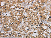 The image on the left is immunohistochemistry of paraffin-embedded Human thyroid cancer tissue using CSB-PA549134(INPPL1 Antibody) at dilution 1/40, on the right is treated with synthetic peptide. (Original magnification: ×200)
