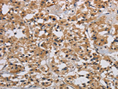 The image on the left is immunohistochemistry of paraffin-embedded Human thyroid cancer tissue using CSB-PA549134(INPPL1 Antibody) at dilution 1/40, on the right is treated with synthetic peptide. (Original magnification: ×200)
