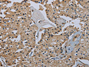 The image on the left is immunohistochemistry of paraffin-embedded Human prostate cancer tissue using CSB-PA549292(FLCN Antibody) at dilution 1/40, on the right is treated with fusion protein. (Original magnification: ×200)