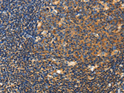 The image on the left is immunohistochemistry of paraffin-embedded Human tonsil tissue using CSB-PA549396(CERK Antibody) at dilution 1/50, on the right is treated with fusion protein. (Original magnification: ×200)