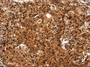 The image on the left is immunohistochemistry of paraffin-embedded Human gastic cancer tissue using CSB-PA549629(LIN28A Antibody) at dilution 1/15, on the right is treated with synthetic peptide. (Original magnification: ×200)