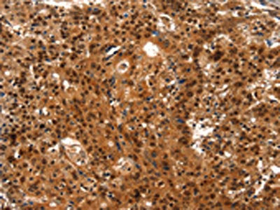 The image on the left is immunohistochemistry of paraffin-embedded Human gastic cancer tissue using CSB-PA549629(LIN28A Antibody) at dilution 1/15, on the right is treated with synthetic peptide. (Original magnification: ×200)