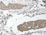 The image on the left is immunohistochemistry of paraffin-embedded Human breast cancer tissue using CSB-PA549727(SREBF2 Antibody) at dilution 1/40, on the right is treated with synthetic peptide. (Original magnification: ×200)