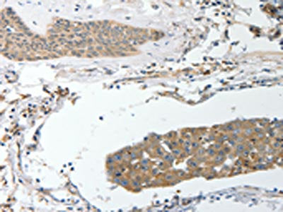 The image on the left is immunohistochemistry of paraffin-embedded Human breast cancer tissue using CSB-PA549727(SREBF2 Antibody) at dilution 1/40, on the right is treated with synthetic peptide. (Original magnification: ×200)
