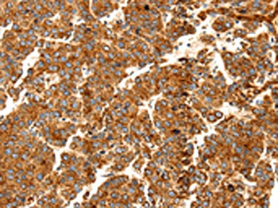 The image on the left is immunohistochemistry of paraffin-embedded Human liver cancer tissue using CSB-PA549792(DOPEY1 Antibody) at dilution 1/25, on the right is treated with synthetic peptide. (Original magnification: ×200)