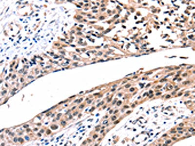 The image on the left is immunohistochemistry of paraffin-embedded Human esophagus cancer tissue using CSB-PA549840(GJB2 Antibody) at dilution 1/100, on the right is treated with synthetic peptide. (Original magnification: ×200)
