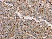 The image on the left is immunohistochemistry of paraffin-embedded Human liver cancer tissue using CSB-PA550013(KIF17 Antibody) at dilution 1/40, on the right is treated with synthetic peptide. (Original magnification: ×200)