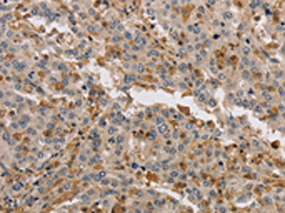 The image on the left is immunohistochemistry of paraffin-embedded Human liver cancer tissue using CSB-PA550013(KIF17 Antibody) at dilution 1/40, on the right is treated with synthetic peptide. (Original magnification: ×200)