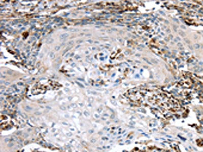 The image on the left is immunohistochemistry of paraffin-embedded Human cervical cancer tissue using CSB-PA550037(TBXA2R Antibody) at dilution 1/40, on the right is treated with synthetic peptide. (Original magnification: ×200)