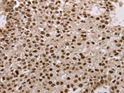 The image on the left is immunohistochemistry of paraffin-embedded Human breast cancer tissue using CSB-PA550074(AKAP8L Antibody) at dilution 1/15, on the right is treated with fusion protein. (Original magnification: ×200)
