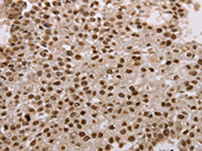 The image on the left is immunohistochemistry of paraffin-embedded Human breast cancer tissue using CSB-PA550074(AKAP8L Antibody) at dilution 1/15, on the right is treated with fusion protein. (Original magnification: ×200)