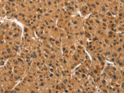 The image on the left is immunohistochemistry of paraffin-embedded Human liver cancer tissue using CSB-PA550437(CCNT1 Antibody) at dilution 1/30, on the right is treated with synthetic peptide. (Original magnification: ×200)