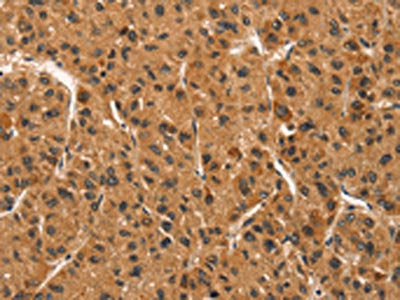 The image on the left is immunohistochemistry of paraffin-embedded Human liver cancer tissue using CSB-PA550437(CCNT1 Antibody) at dilution 1/30, on the right is treated with synthetic peptide. (Original magnification: ×200)