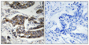 Immunohistochemical analysis of paraffin-embedded human breast carcinoma tissue using Girdin (Phospho-Ser1417) antibody (left)or the same antibody preincubated with blocking peptide (right).