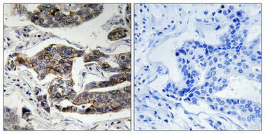 Immunohistochemical analysis of paraffin-embedded human breast carcinoma tissue using Girdin (Phospho-Ser1417) antibody (left)or the same antibody preincubated with blocking peptide (right).