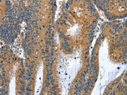 The image on the left is immunohistochemistry of paraffin-embedded Human colon cancer tissue using CSB-PA550582(ANAPC10 Antibody) at dilution 1/30, on the right is treated with fusion protein. (Original magnification: ×200)