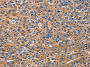 The image on the left is immunohistochemistry of paraffin-embedded Human liver cancer tissue using CSB-PA551201(NCR2 Antibody) at dilution 1/60, on the right is treated with synthetic peptide. (Original magnification: ×200)