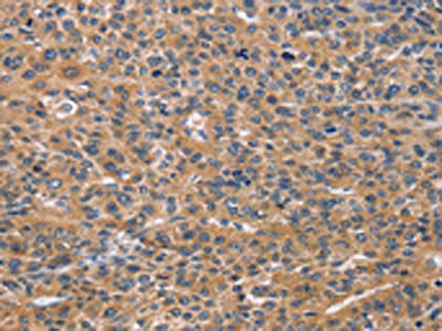 The image on the left is immunohistochemistry of paraffin-embedded Human liver cancer tissue using CSB-PA551201(NCR2 Antibody) at dilution 1/60, on the right is treated with synthetic peptide. (Original magnification: ×200)