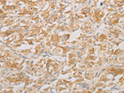 The image on the left is immunohistochemistry of paraffin-embedded Human thyroid cancer tissue using CSB-PA551903(AES Antibody) at dilution 1/20, on the right is treated with fusion protein. (Original magnification: ×200)