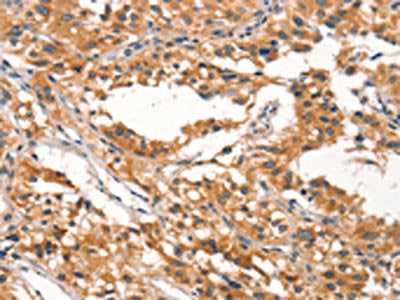 The image on the left is immunohistochemistry of paraffin-embedded Human thyroid cancer tissue using CSB-PA551921(RHOBTB2 Antibody) at dilution 1/30, on the right is treated with synthetic peptide. (Original magnification: ×200)