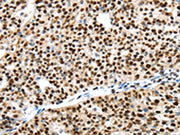 The image on the left is immunohistochemistry of paraffin-embedded Human breast cancer tissue using CSB-PA551947(UBA1 Antibody) at dilution 1/40, on the right is treated with synthetic peptide. (Original magnification: ×200)