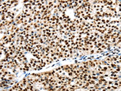 The image on the left is immunohistochemistry of paraffin-embedded Human breast cancer tissue using CSB-PA551947(UBA1 Antibody) at dilution 1/40, on the right is treated with synthetic peptide. (Original magnification: ×200)