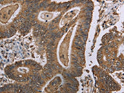 The image on the left is immunohistochemistry of paraffin-embedded Human colon cancer tissue using CSB-PA552097(MRGPRX1 Antibody) at dilution 1/40, on the right is treated with synthetic peptide. (Original magnification: ×200)