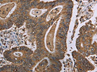 The image on the left is immunohistochemistry of paraffin-embedded Human colon cancer tissue using CSB-PA552097(MRGPRX1 Antibody) at dilution 1/40, on the right is treated with synthetic peptide. (Original magnification: ×200)